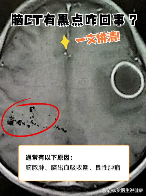 计算机体层摄影（CT）在脑科疾病中的应用与价值